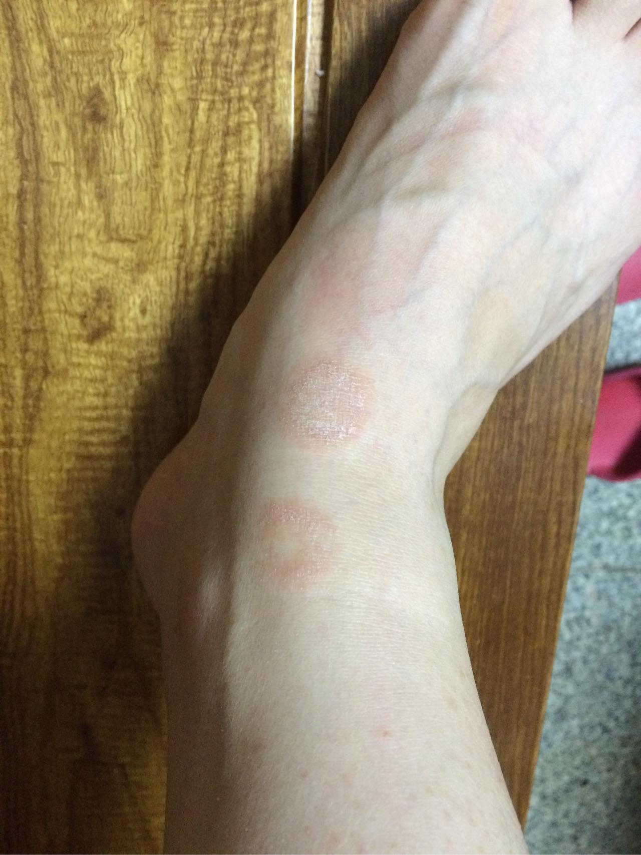 脚背上无意间长了癣痒的不行怎么办