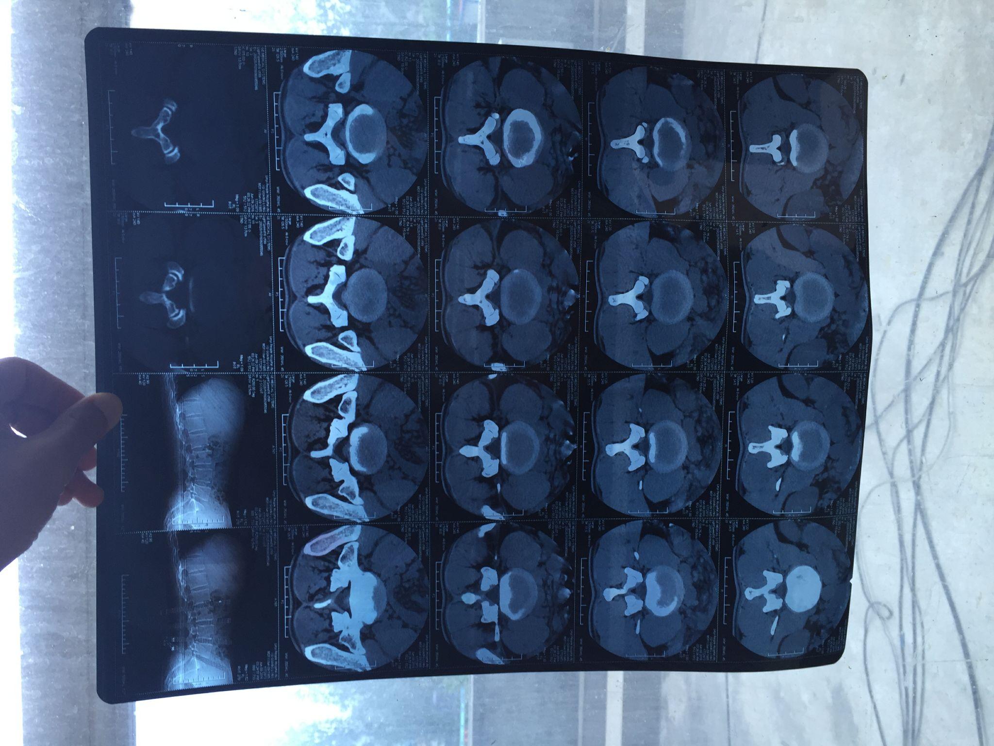 腰椎间盘突出压迫神经需要手术么?