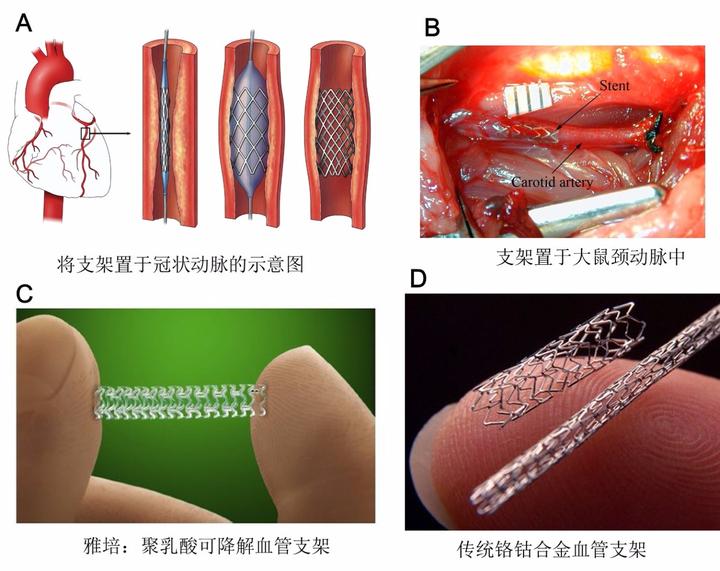 《新英格兰医学杂志》：可降解的冠状动脉支架 - 知乎
