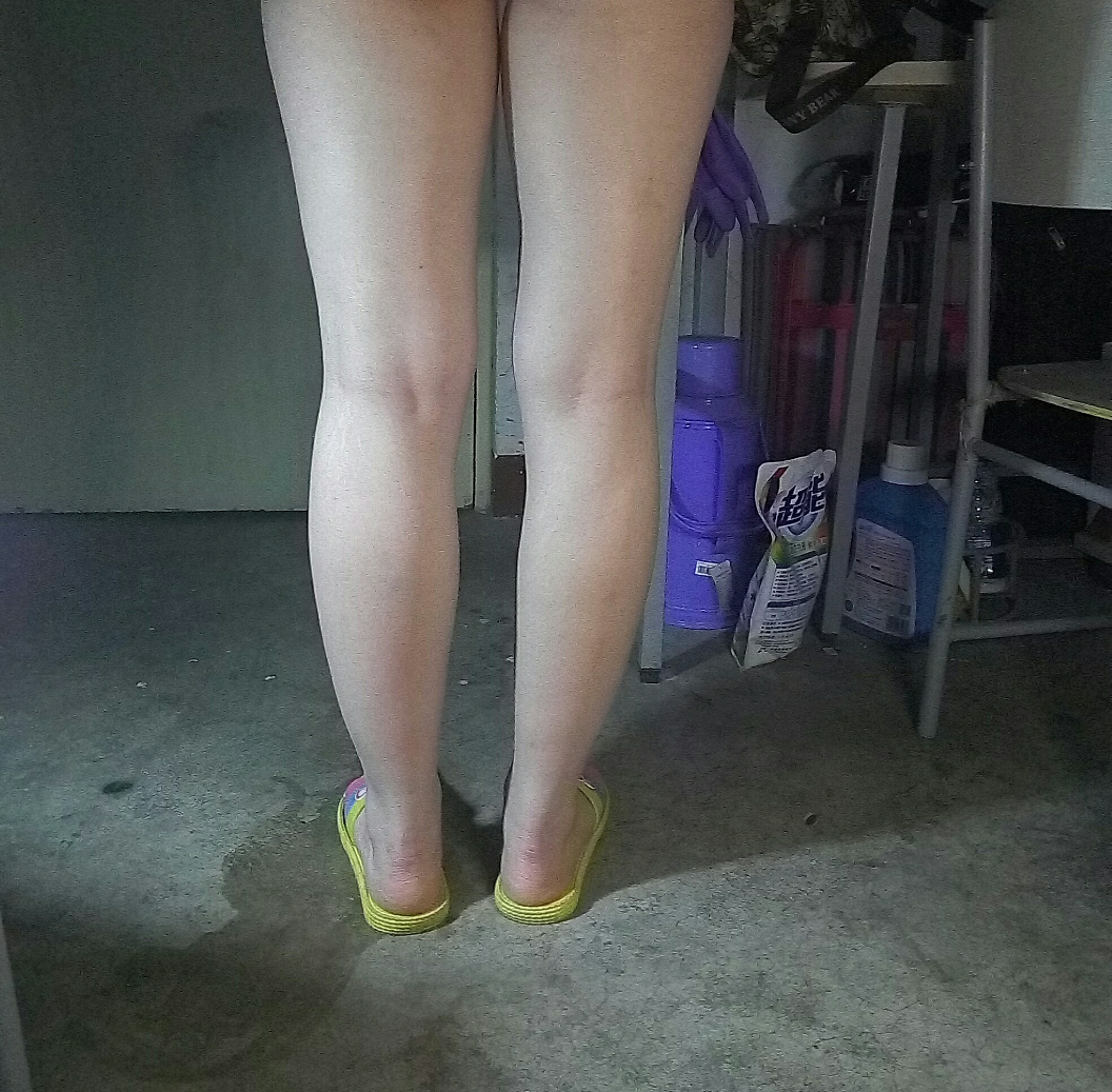 我俩腿不一样粗细,请问看腿能看出问题来吗?我