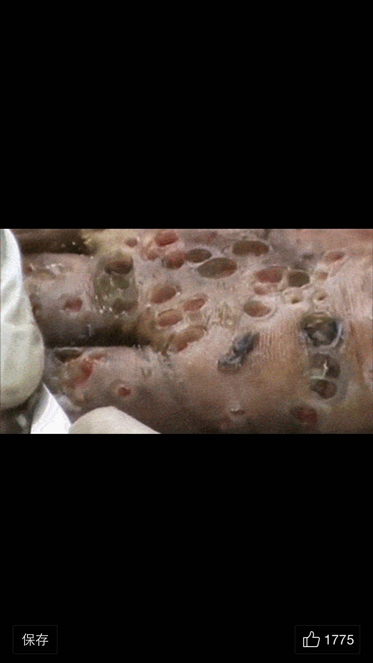 有密集恐惧症的医学生或医生是怎样的体验