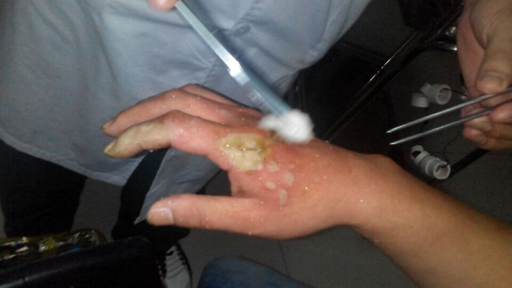 家里做饭着火,救火时右手手背及食指被油烫伤,重二度至三度,是否需要