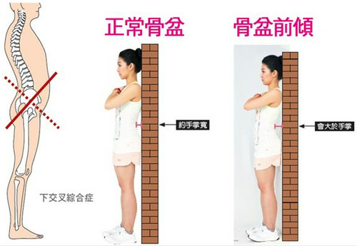 怎么矫正骨盆后倾 知乎 怎么矫正骨盆后倾 知乎