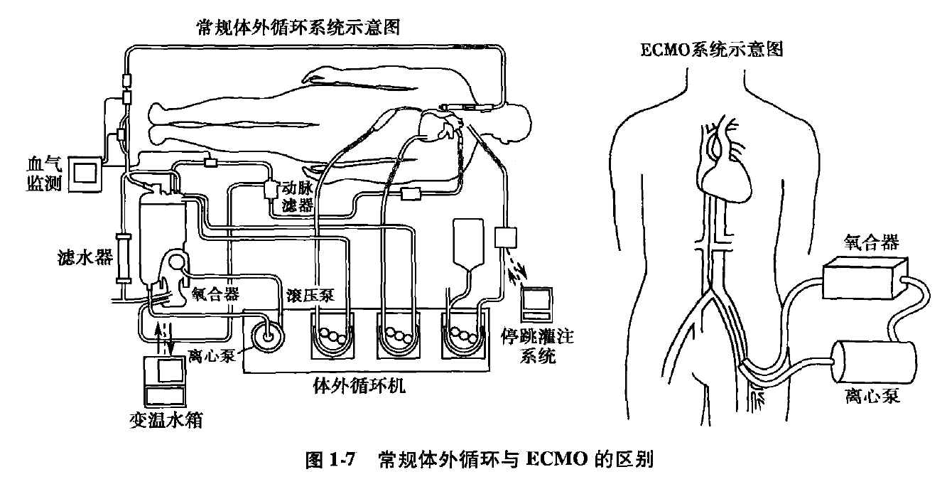 1 ecmo主要的作用是人工心 人工肺,号称可以在体外彻底替代心脏 返哪