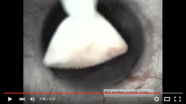 吸烟对矫正视力的伤害,别让烟雾蒙蔽了你的双眼