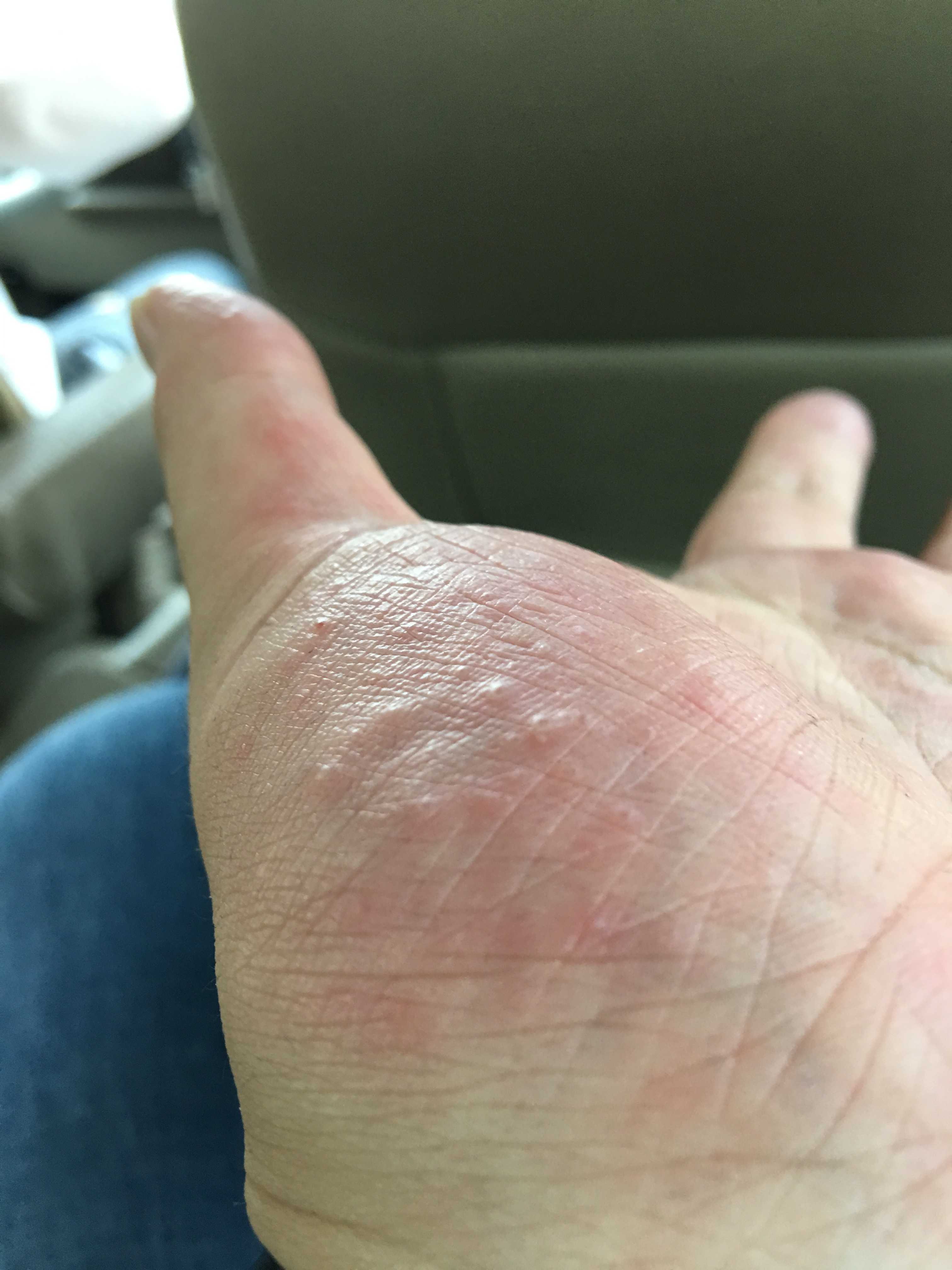 而且时间持续很久了,网上也查过很多资料,有说是汗疱疹或者其他什么的