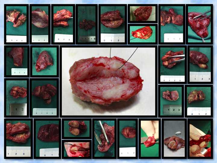 甲状腺结节怎么确诊良性还是恶性?