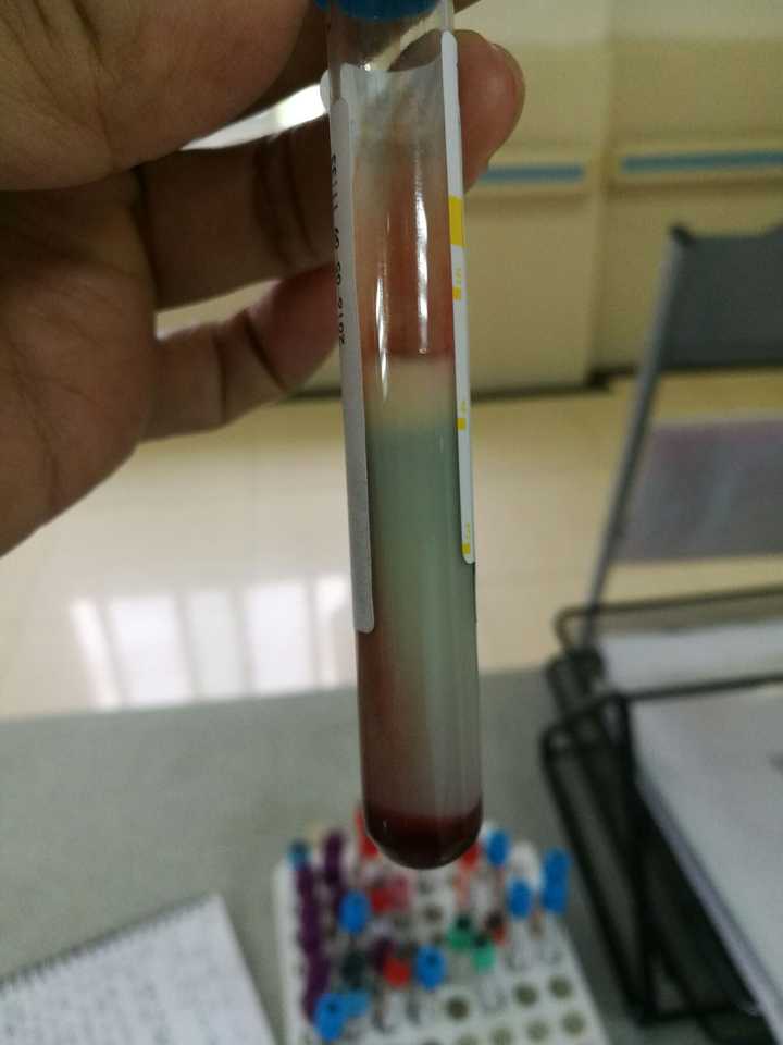 这张图送给题主,这叫"脂血",就是血管里的甘油三酯浓稠到可以自动分离