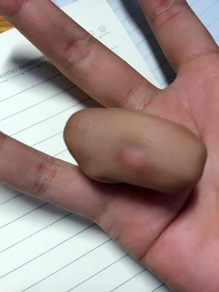 你们有哪些让人匪夷所思的老茧?