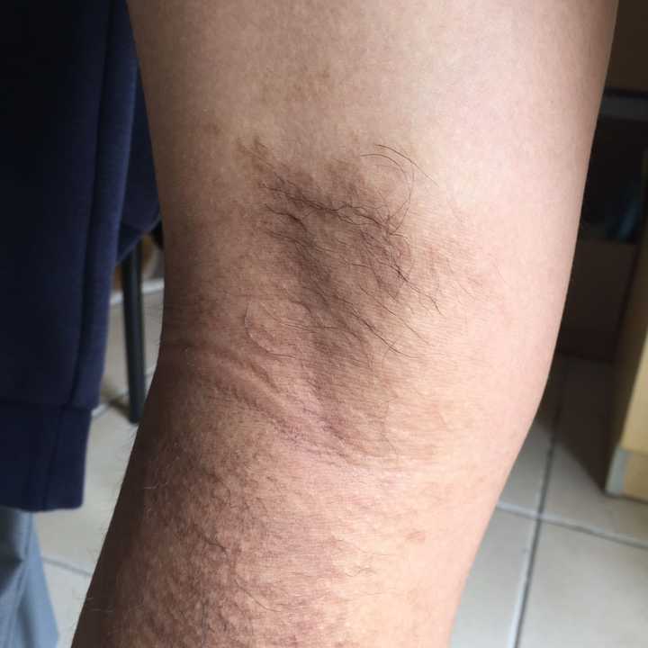 小时候皮炎误用药物导致皮肤一大片黑,还有救吗?