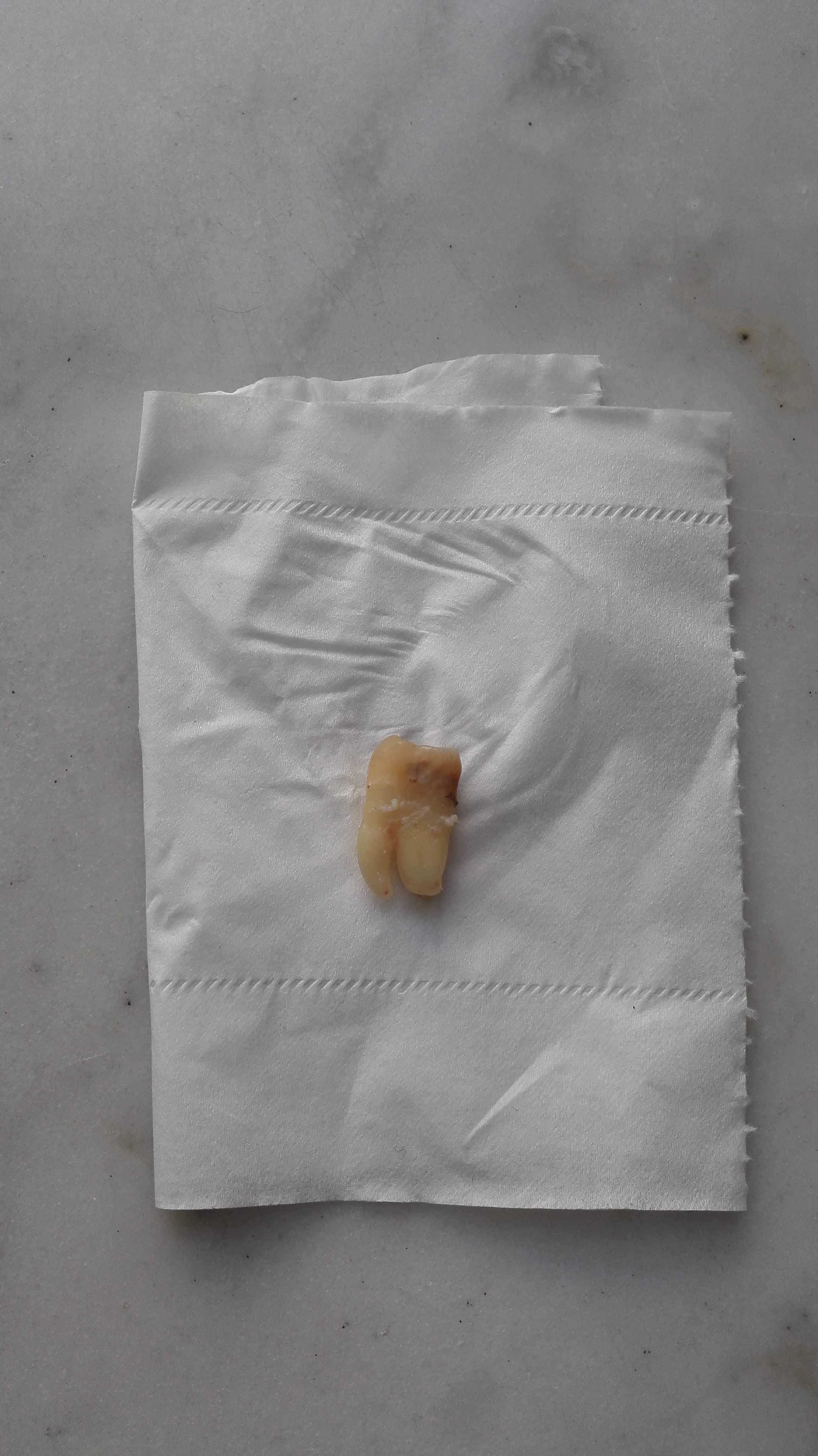 都别拦着我! 拔过5颗牙齿(4颗智齿 1颗磨牙)的人来怒答一下!