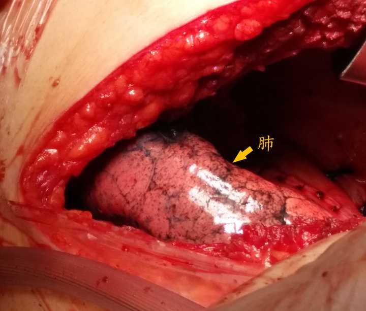 本例還可以看到腎盂附近的脂肪組織. 三,生殖系統 1.