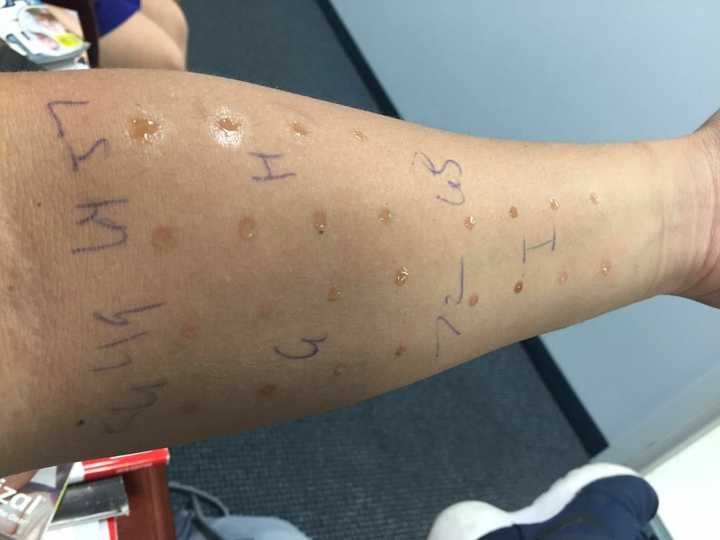 那时候喷嚏不断,鼻子堵得睡不着觉,眼睛痒,咳嗽,怀疑是猫过敏,医生