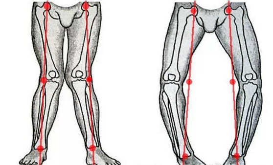 如何让腿变直 知乎