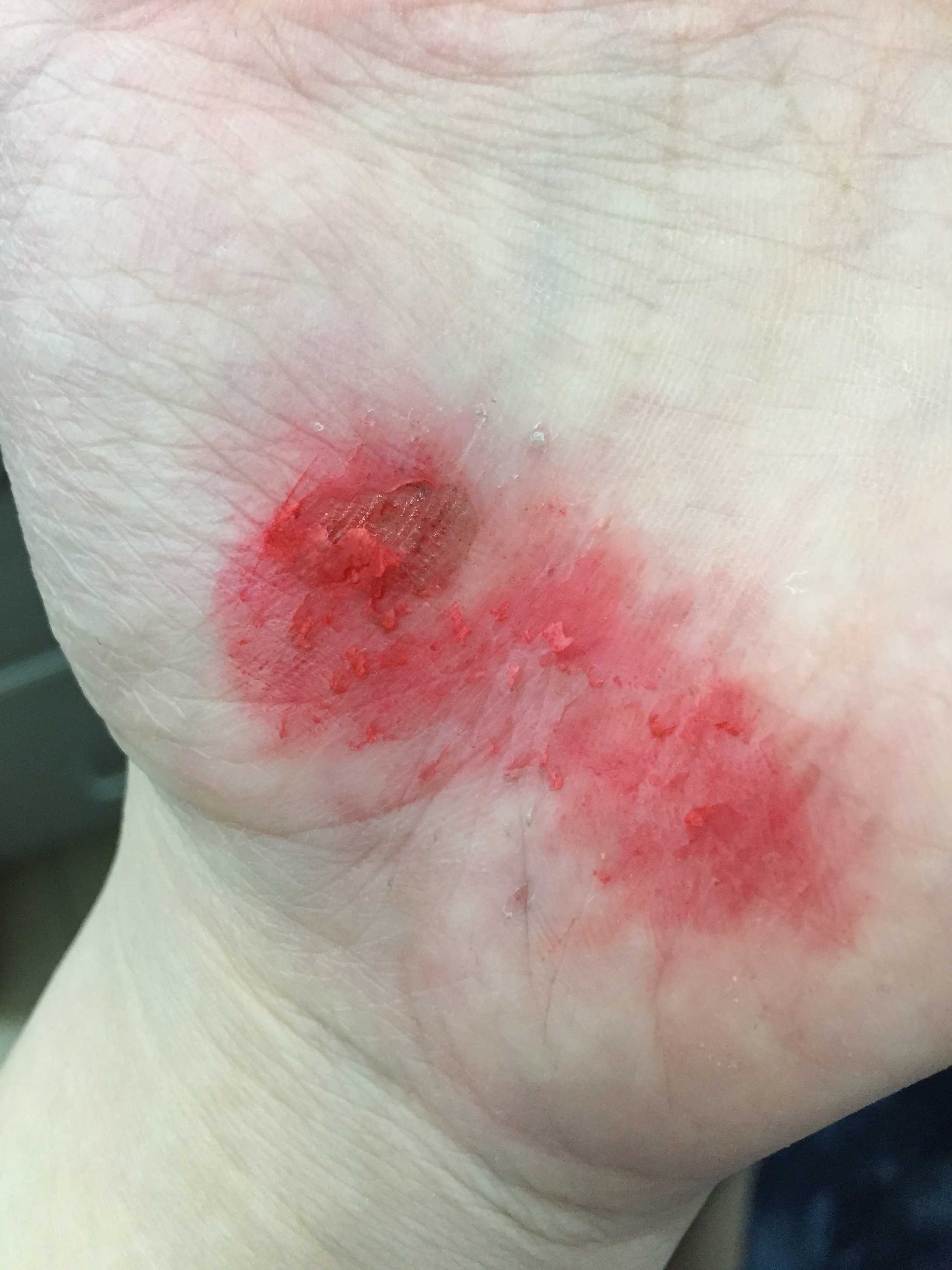 偶然看到这个问题,想起以前有一次打球,抢球时被绊了一跤在地上滑行