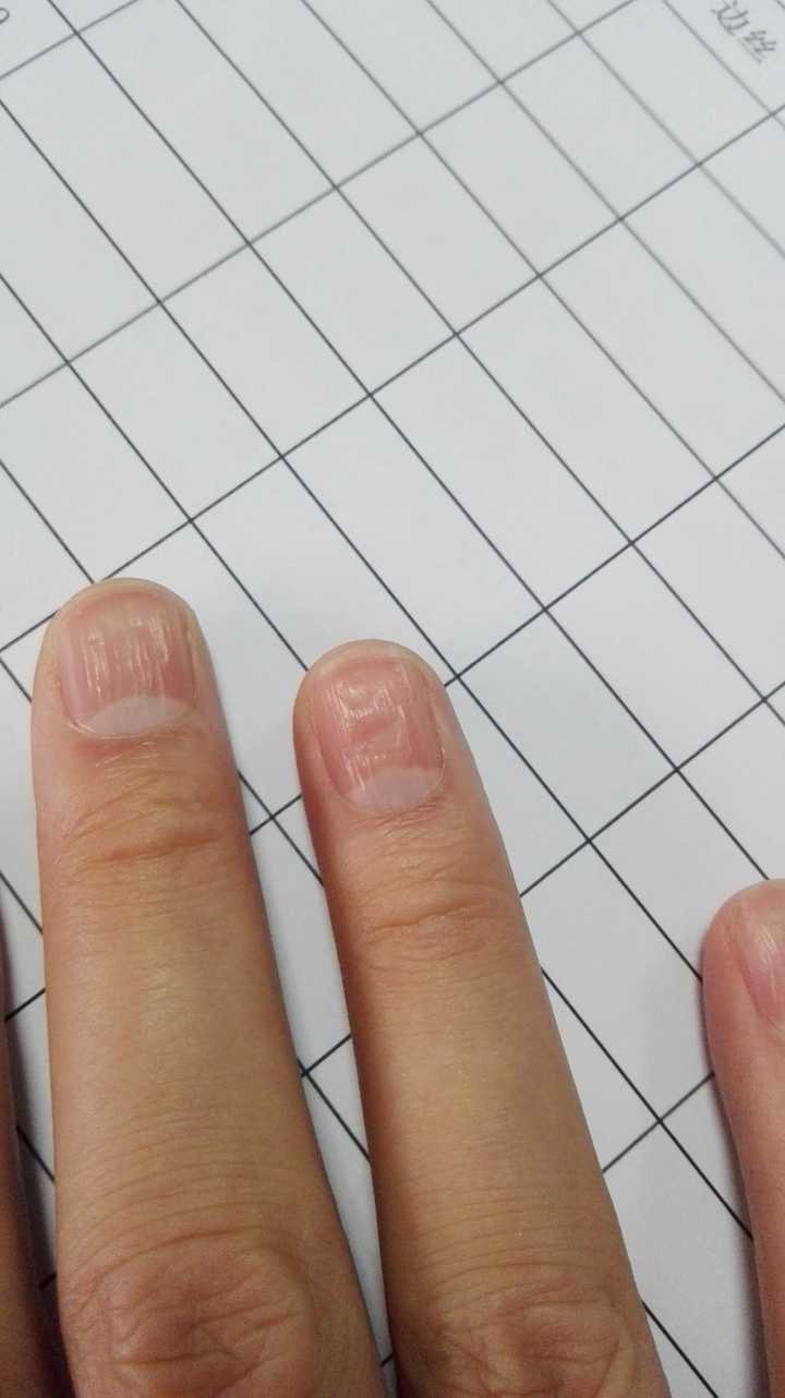 手指甲凹陷是怎么回事图片