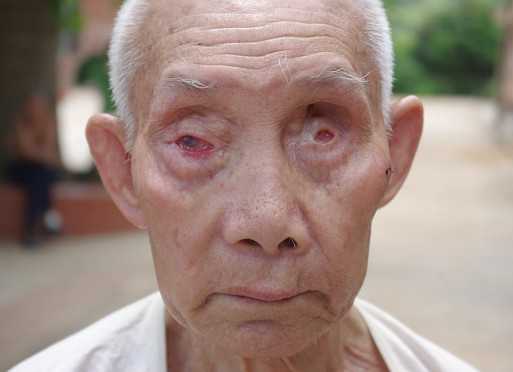 我国现在对麻风病人的处理方式是怎样的?