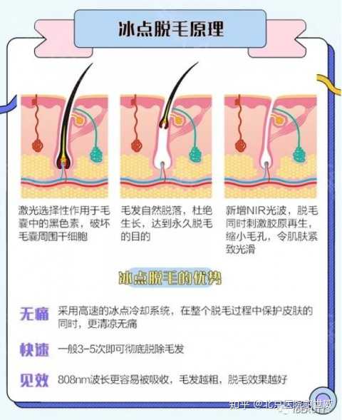 冰点脱毛是什么体验 知乎