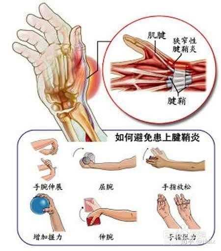怎么可以治好腱鞘炎？