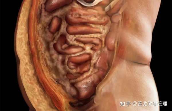 管戈健康管理 的想法: 胖人的肚子里,到底有什么?#肥胖# - 知乎