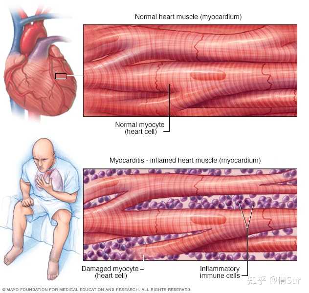商汤科技一员工健身后猝死是否和健身有关怎样判断自身