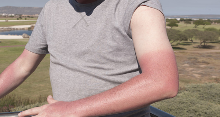 一些人认为紫外线对皮肤造成的损伤只是晒黑或晒伤,其实紫外线对皮肤