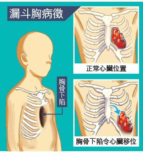 鸡胸的人能通过健身弥补身材的缺陷吗 知乎