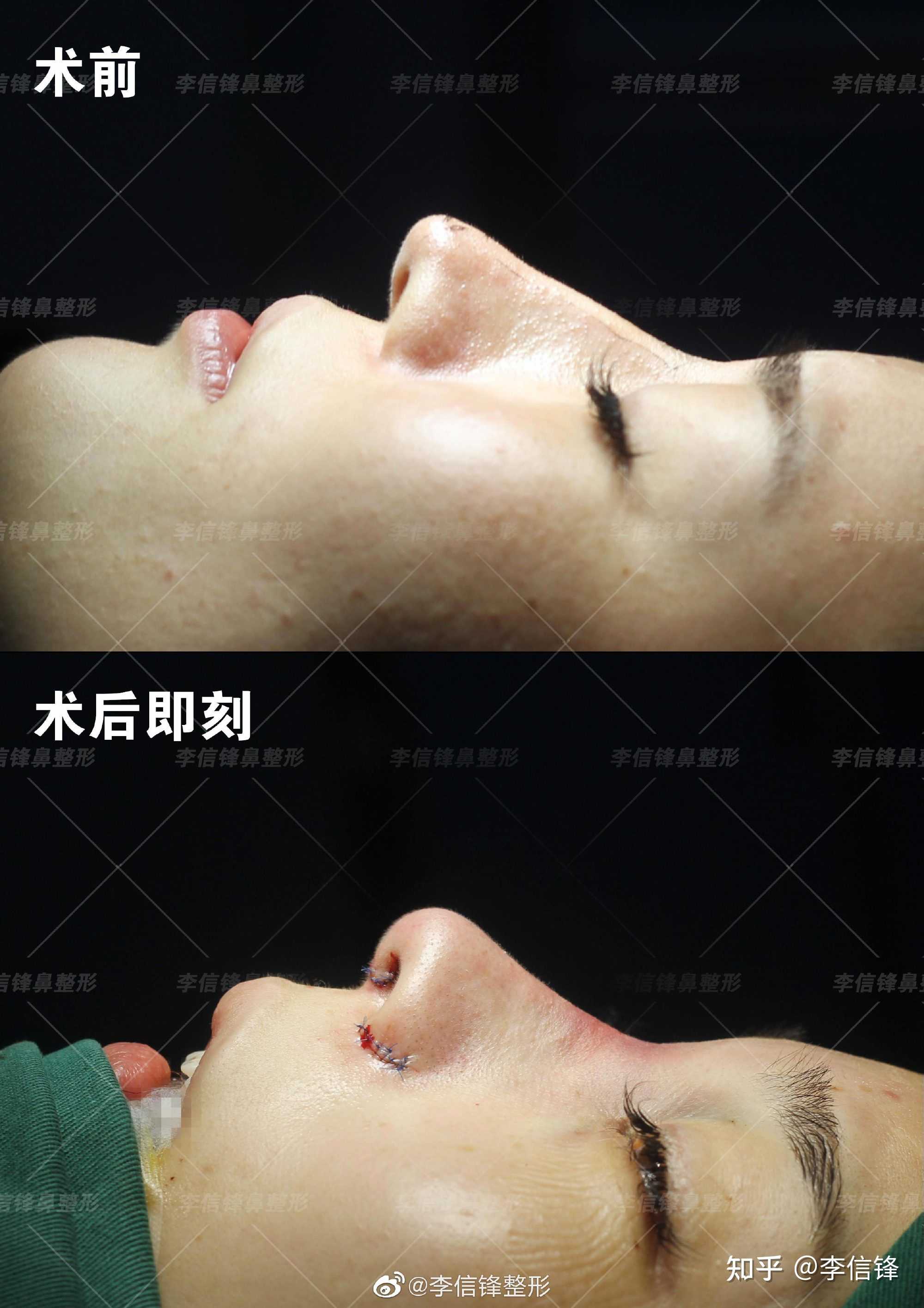 鼻翼外擴鼻骨略寬等情況美女喜歡偏自然款微翹鼻型鼻頭有肉感飽滿一點