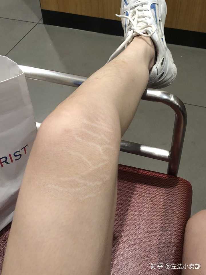 生长纹肥胖纹白色的有点波浪线的有淡化成功的么