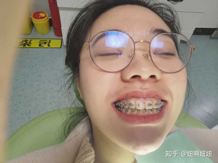 是什么原因让你下定决心（戴牙套）牙齿矫正？
