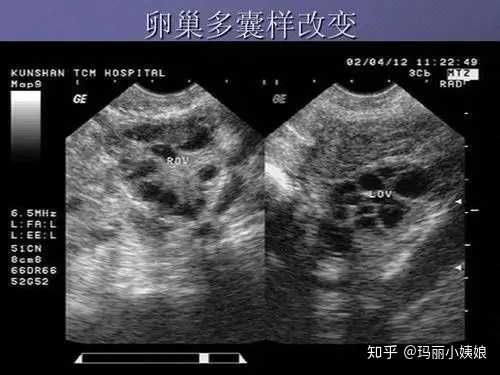 我b超檢查顯示卵巢多囊樣改變.還沒有檢查內分泌