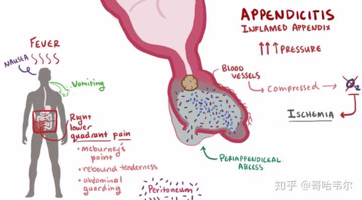 关于阑尾炎 普通人有哪些需要知道的知识 知乎