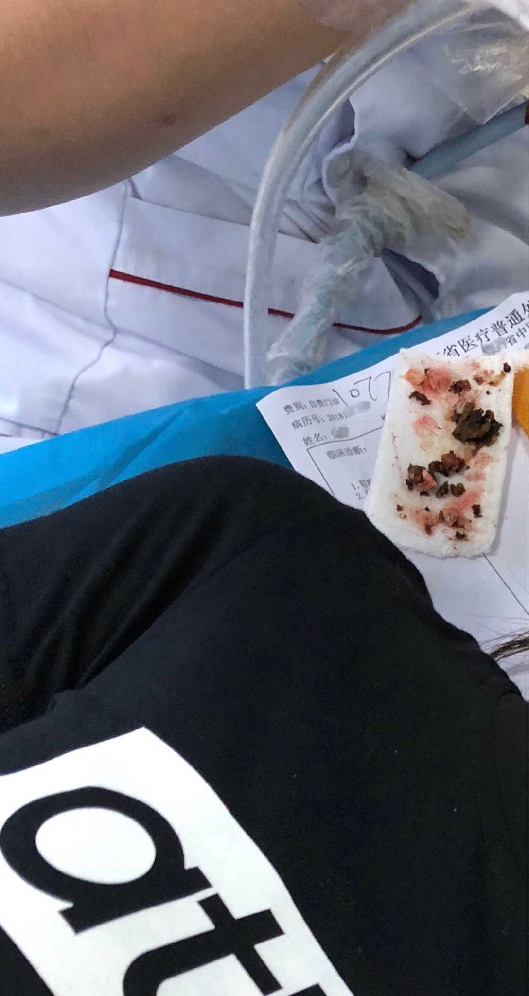 你们能想到我因为耳屎太多,拴塞,导致耳损伤,黏膜坏死,鼓膜穿了个