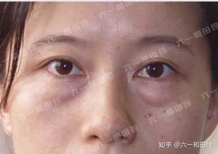 不做手术如何去眼袋 知乎 不做手术如何去眼袋 知乎