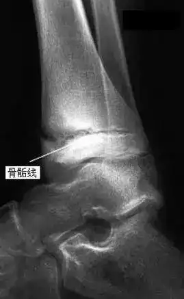 男生21岁,183,骨骼有点闭合了,怎么做才能长高