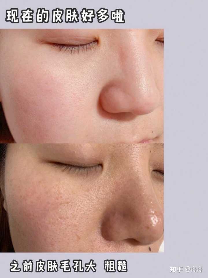 脸上毛孔粗大可以变好吗