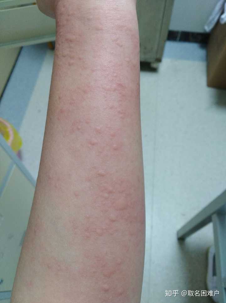 荨麻疹能治愈吗 知乎 荨麻疹能治愈吗 知乎
