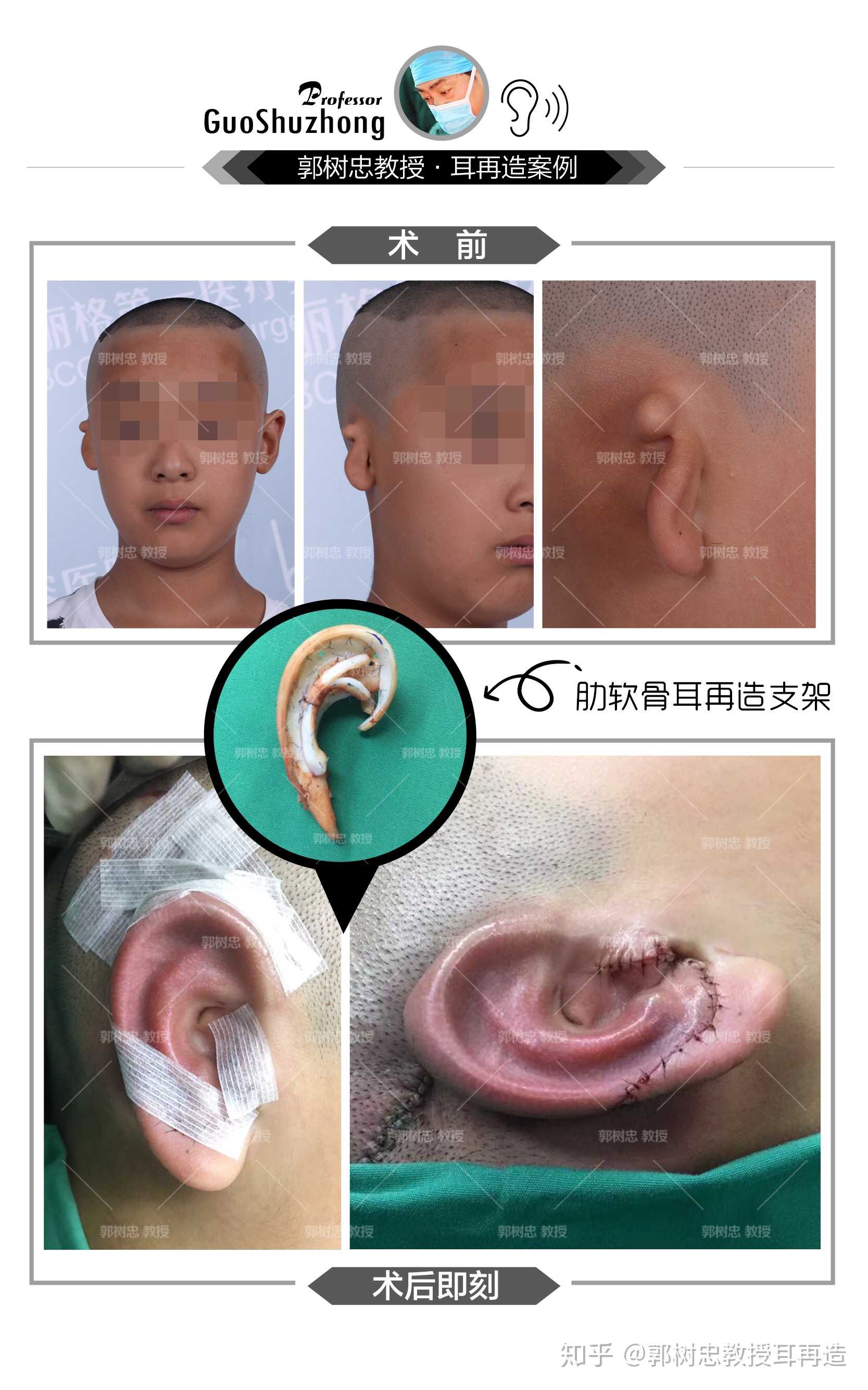 郭树忠耳再造案例