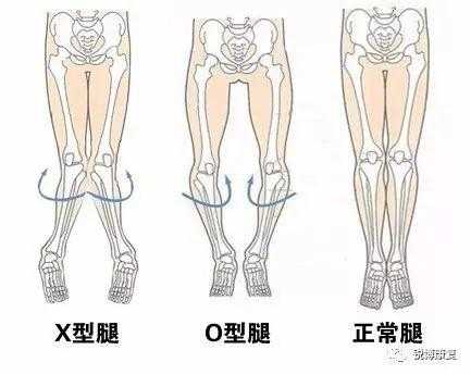 O型腿如何矫正? - 知乎