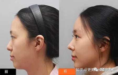 塌鼻子是一种什么样的体验 知乎 塌鼻子是一种什么样的体验 知乎