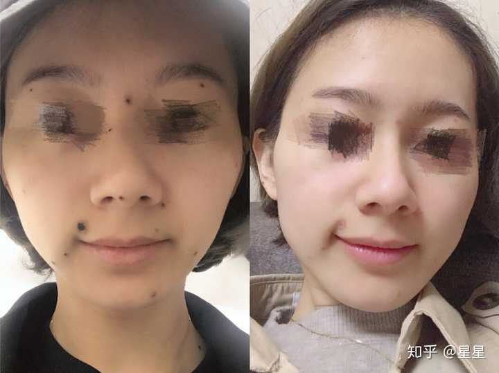 祛痣是种什么样的体验.
