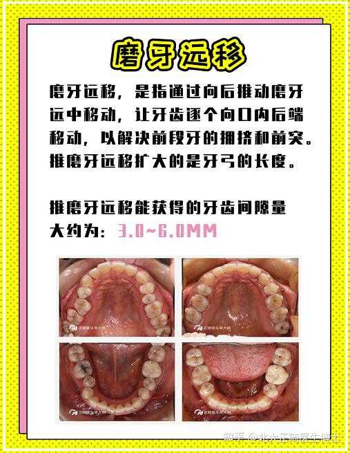 磨牙后移#