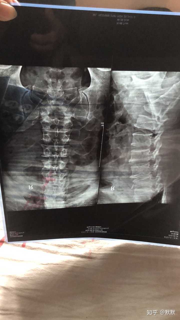 腰椎骨折爆裂性骨折怎么说