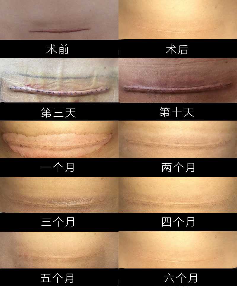 瘢痕疙瘩治疗术后效果