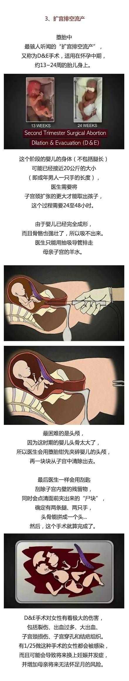 堕胎婴儿图片图片