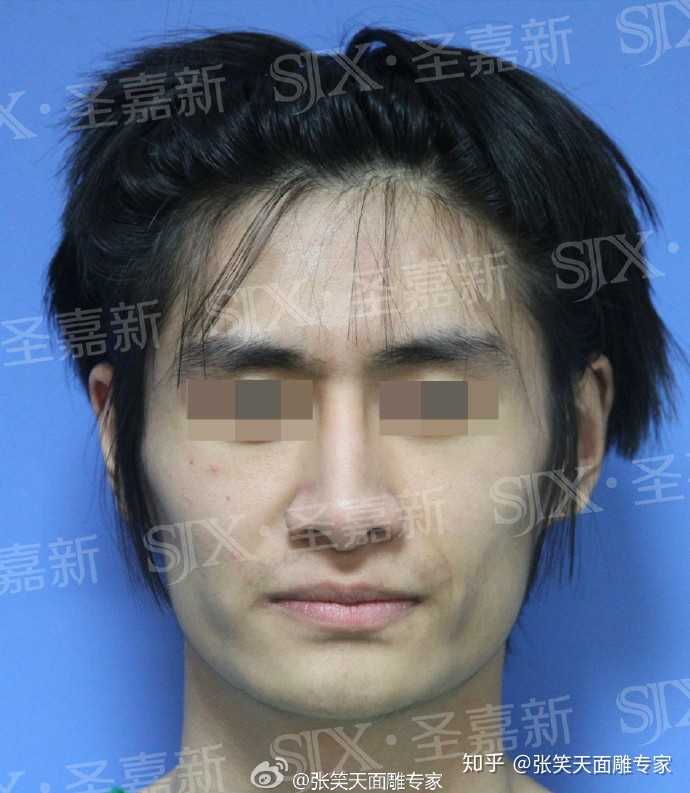 我一个男生想去削骨,可以吗?