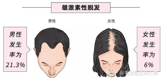 雄激素性脱发的病因雄激素性脱发也称之为脂溢性脱发、遗传脱发,最根本