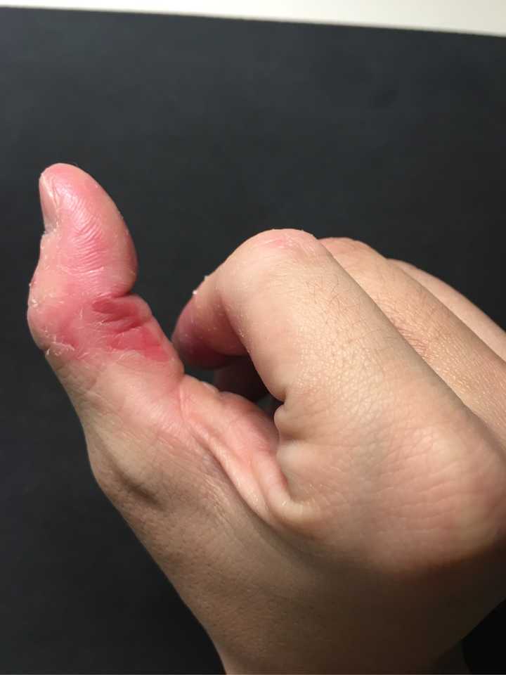 如何戒掉咬手指的习惯