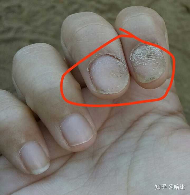 指甲盖干裂怎么办求解