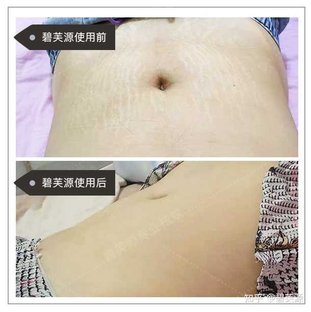 怀孕期间长妊娠纹有什么征兆吗 刚开始长是什么样子啊 知乎 怀孕期间长妊娠纹有什么征兆吗 刚开始长是什么样子啊 知乎